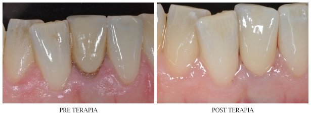 Corona in Zirconia